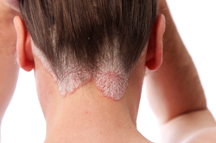 Psoriasis drugs not bad for your heart
